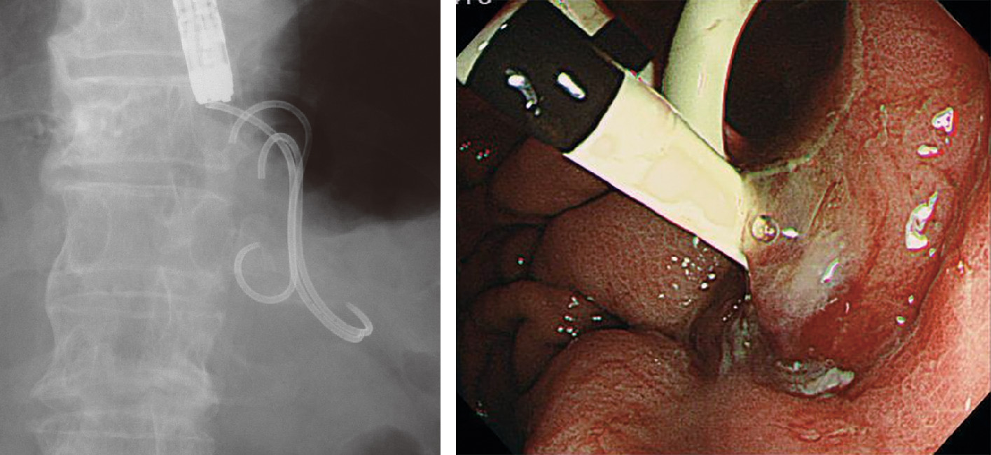 ⓔ図12-29-5　膵仮性嚢胞に対するEUSガイド下嚢胞ドレナージ 