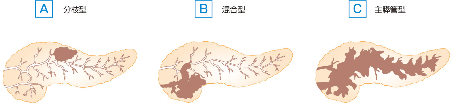ⓔ図12-29-6　IPMNの形態学的型分類 
