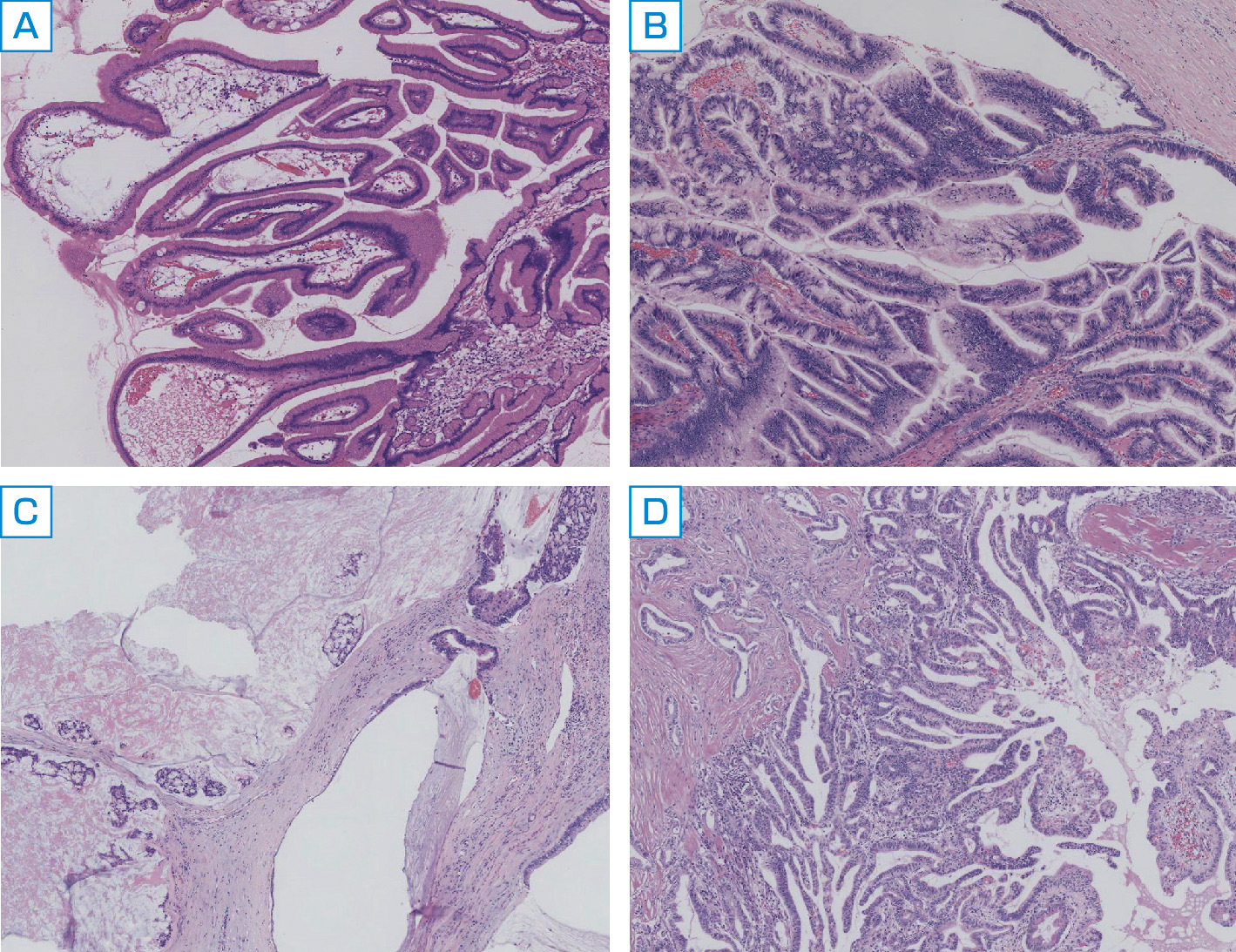 ⓔ図12-29-7　IPMNの組織診断 A：膵管内乳頭粘液性腺腫．low–grade IPMN. B：非浸潤性膵管内乳頭粘液性腺癌．high–grade IPMN. C, D：浸潤性膵管内乳頭粘液性腺癌．IPMN with associated invasive carcinoma．浸潤性腺癌では粘液癌 (C)，あるいは，管状腺癌 (D) の形態をとることが多い． ヘマトキシリン・エオジン染色．原図×100．