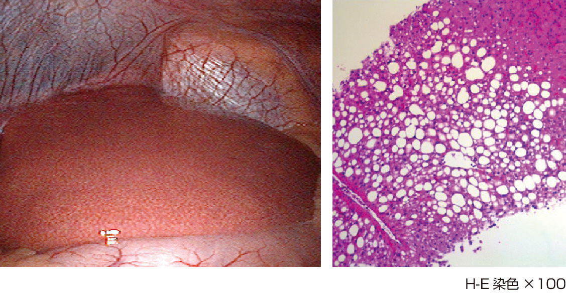 ⓔ図12-5-1　NAFLの腹腔鏡像と病理組織像 