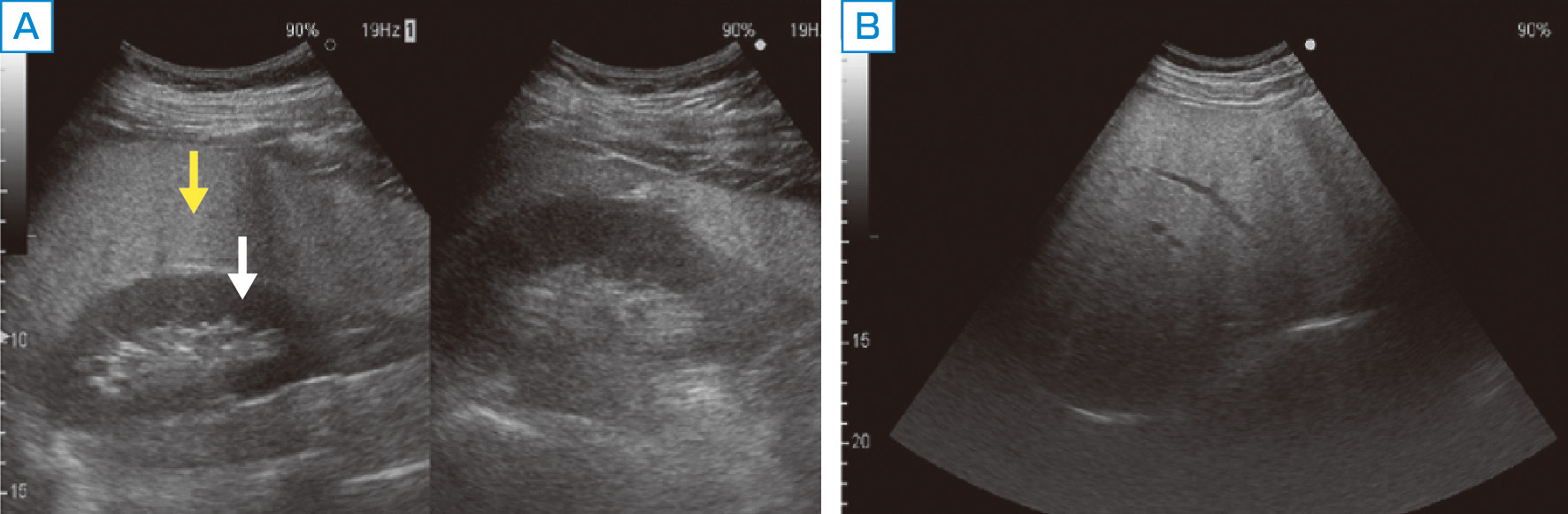 ⓔ図12-5-2　NAFLDの腹部超音波像 (Bモード) A：肝腎コントラスト，bright liverを認める．肝臓 (黄色矢印)，腎臓 (白矢印)． B：深部エコーの減衰，脈管の不明瞭化を認める．