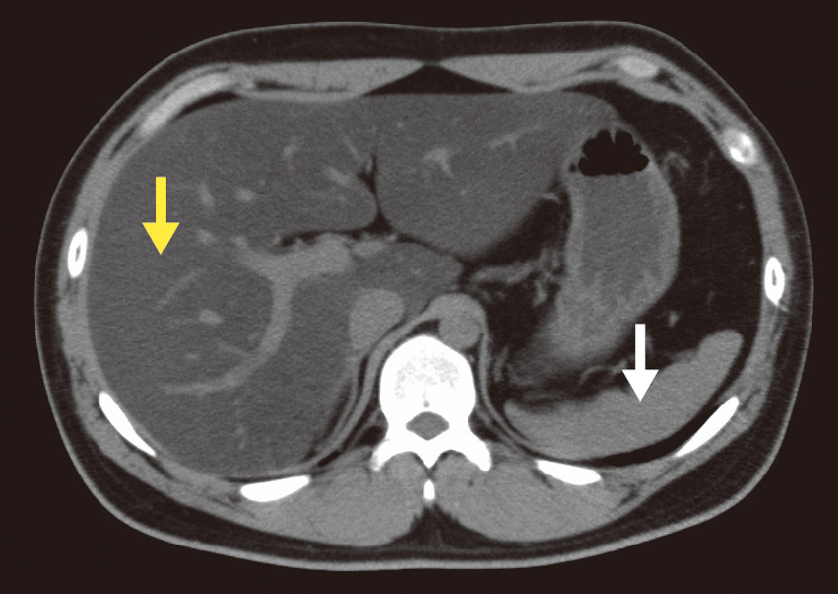 ⓔ図12-5-3　NAFLDの腹部CT画像 (単純) 肝臓内部のCT値 (黄色矢印) が脾臓 (白矢印) より低下し，また脈管が浮き出てみえる．
