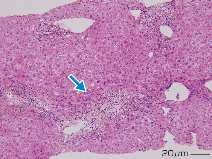 ⓔ図12-7-1　急性肝炎期のAIH症例の肝生検組織像 門脈域の炎症所見は軽微であり，小葉中心部の壊死炎症像，centrilobular necrosisが観察される (矢印)．