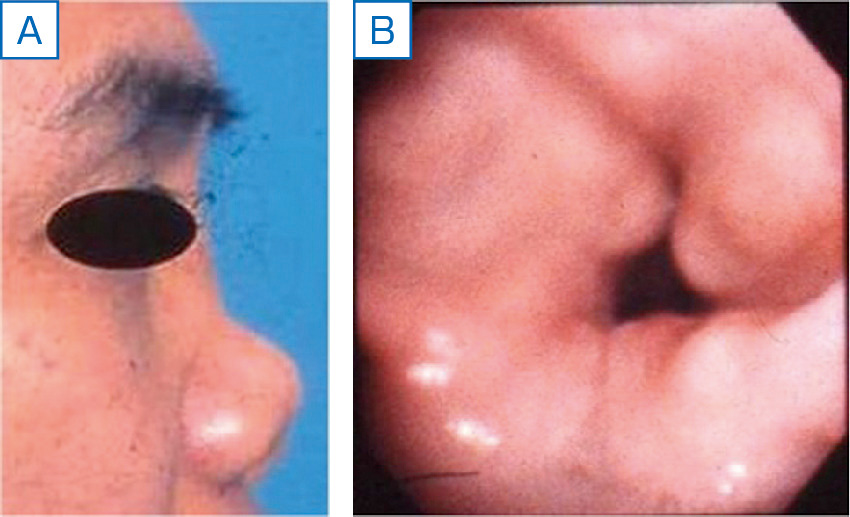 ⓔ図13-12-1　多発関節痛で発症した再発性多発性軟骨炎症例 経過中に鞍鼻 (A) と呼吸困難が出現し，気管支鏡検査で気管狭窄を認めた (B)．