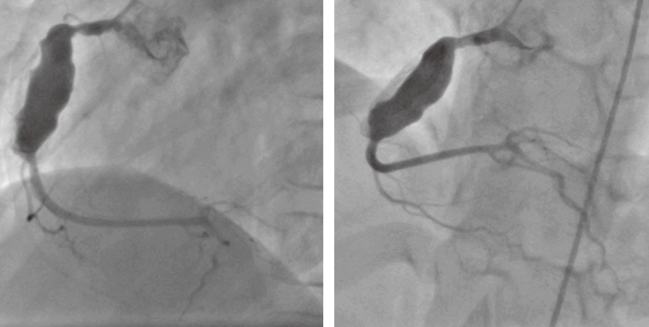 ⓔ図13-19-3　川崎病にみられた冠動脈瘤 (12歳男児) 川崎病の約3％は冠動脈拡張を残し，小児の心筋梗塞の原因となる．この症例では右冠動脈seg1～2にかけてソーセージ様の動脈瘤がみられる．