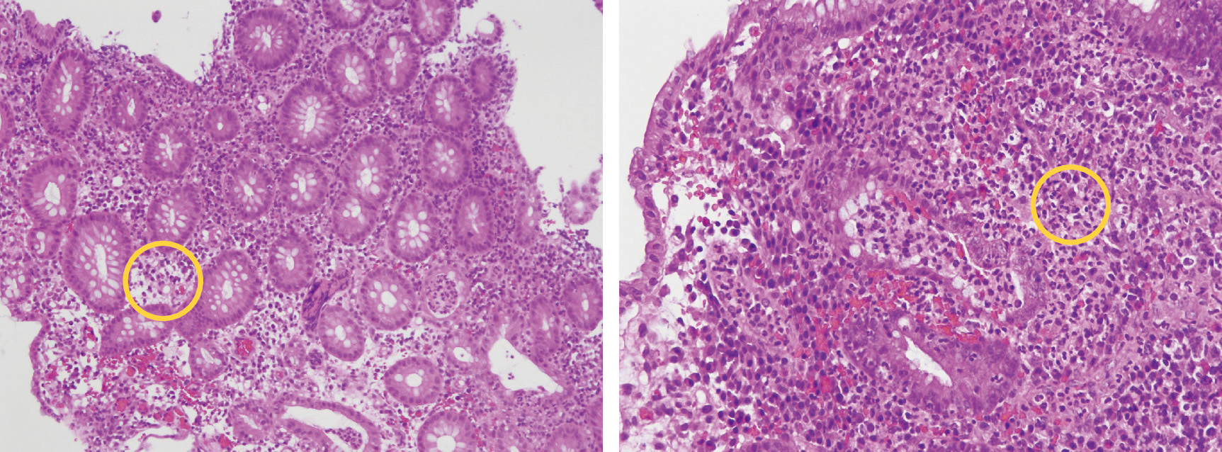 ⓔ図13-2-10　同患者の大腸粘膜生検所見 高度の炎症性細胞浸潤 (左○) と陰窩膿瘍 (右○) を認める．