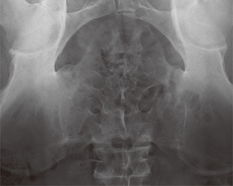 ⓔ図13-2-11　AS患者の骨盤X線 仙腸関節の狭小化を認める．