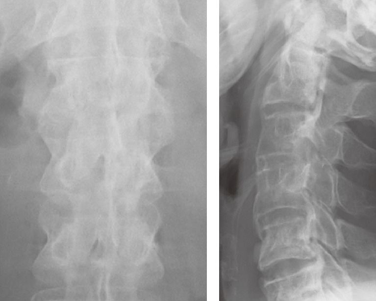 ⓔ図13-2-12　AS患者の腰椎X線，bamboo spineを認める (左)，AS患者の頸椎X線，頸椎の前縁，後縁の癒合を認める (右)． 