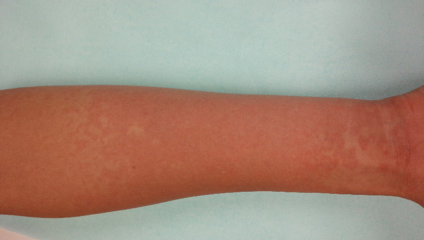 ⓔ図13-2-14　成人Still病にみられる典型的皮疹 