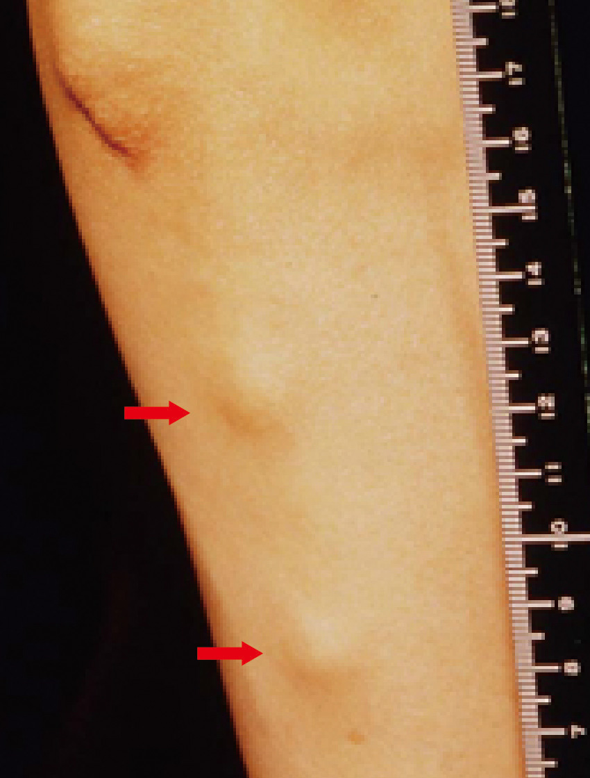 ⓔ図13-2-2　関節外所見 前腕伸側の皮下結節 (リウマトイド結節)．