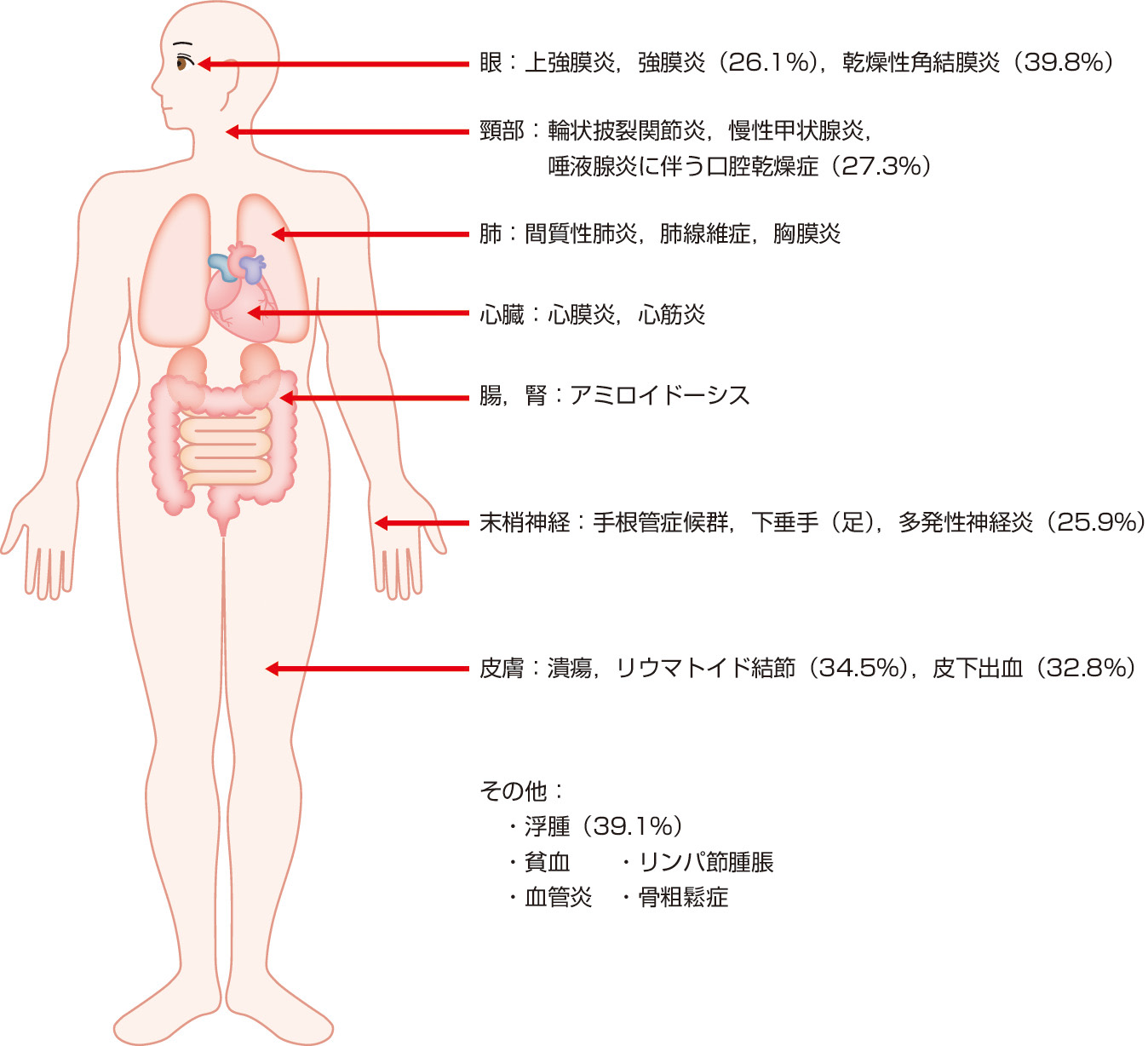 ⓔ図13-2-3　関節リウマチの関節外臓器障害 (日本リウマチ友の会：2010年リウマチ白書，2010) 頻度を示す数字は日本リウマチ友の会．