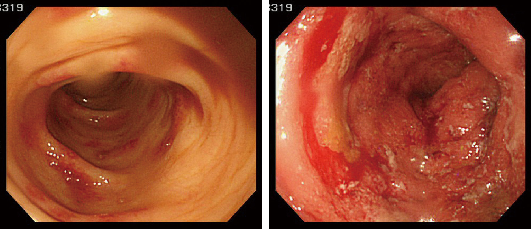ⓔ図13-2-9　潰瘍性大腸炎の大腸内視鏡所見 直腸から連続して発赤びらんが多発している．