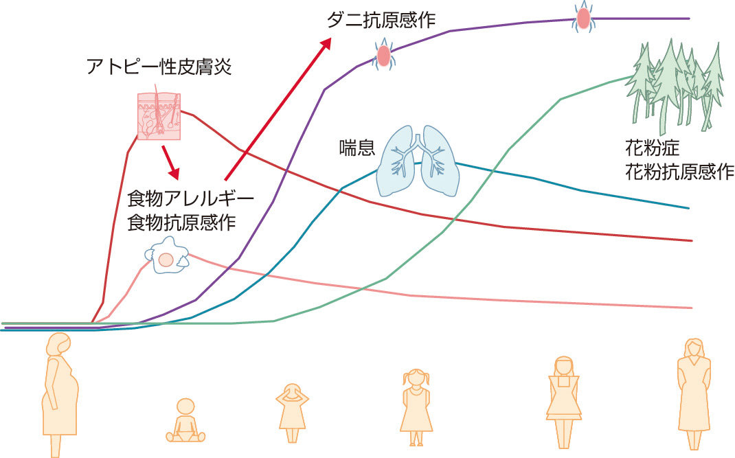 ⓔ図13-23-1　アレルギー・マーチ 生後4カ月までに湿疹 (アトピー性皮膚炎) を発症すると1歳までに食物アレルギーを発症するリスクは高くなり，1歳時点の食物 (卵白) に感作された児は3歳時にダニ抗原に感作されるリスクが高くなる．