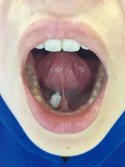 ⓔ図13-23-5　舌下免疫療法の実際 写真のように舌下免疫療法を自宅で行う．舌下して1分以内で溶けるが，5分間は飲水しない．