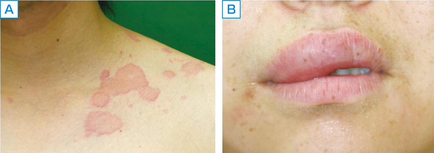 ⓔ図13-35-2　じんま疹の臨床像 A：慢性じんま疹．大小不同の浮腫性紅斑が散在している． B：血管性浮腫．顔面，特に眼瞼，口唇に出現することが多い．遺伝性血管性浮腫では，顔面，四肢の皮膚のほか，舌，咽頭，陰部の浮腫や，腸管浮腫による腹部膨満などの症状が現れることもある．