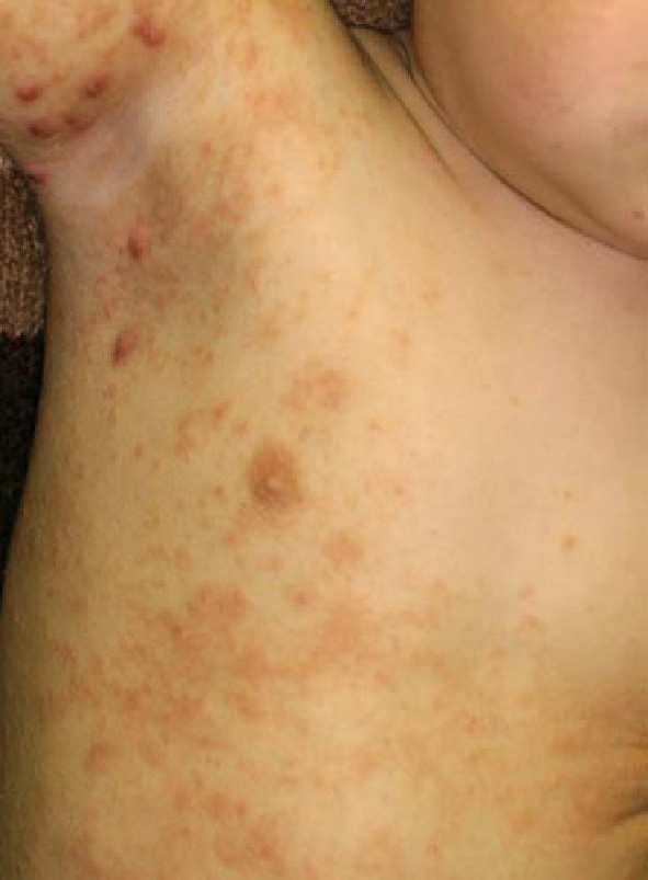 ⓔ図13-35-4　アトピー性皮膚炎の鑑別疾患 (疥癬) 体幹にステロイド外用薬に抵抗する紅褐色の丘疹が多発する．強いかゆみを伴う．