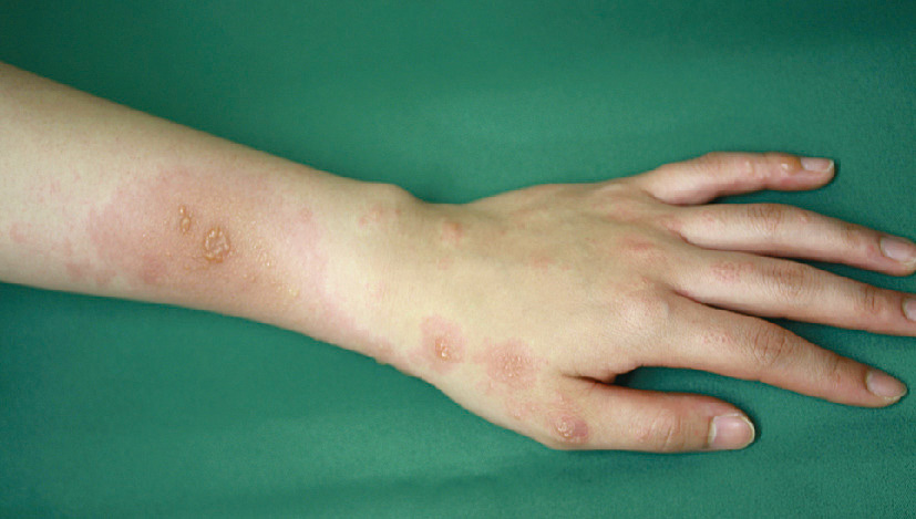 ⓔ図13-35-5　ウルシによるアレルギー性接触皮膚炎 