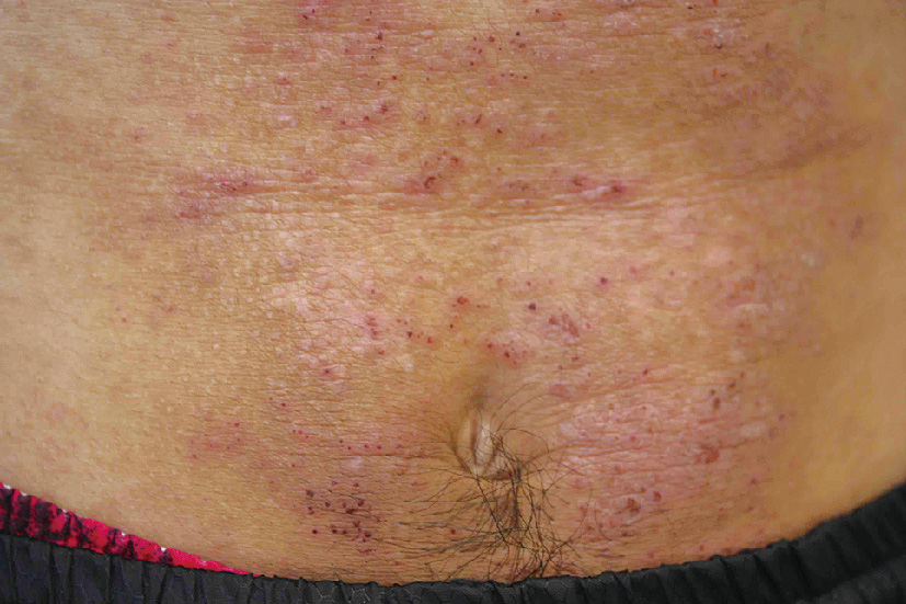 ⓔ図13-35-6　ベルト (バックル) の金属による慢性アレルギー性接触皮膚炎 