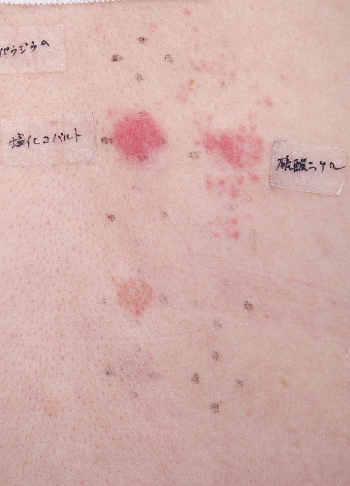 ⓔ図13-35-7　貼付試験 (パッチテスト) 