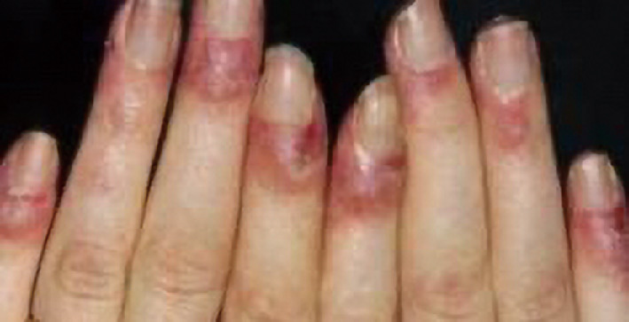 ⓔ図13-4-2　手指の血管炎 