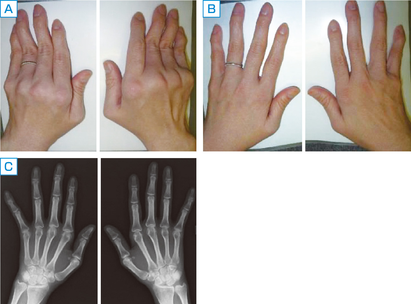 ⓔ図13-4-4　Jaccoud様関節炎 関節リウマチのような関節変形を認める (A) が，修復可能であり (B)，関節破壊を伴わない (C)．