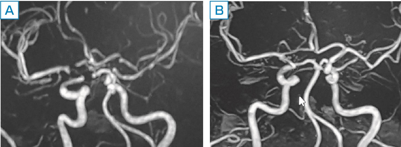 ⓔ図13-4-5　NPSLE SLEの経過中，意識障害があり中枢神経血管炎と診断した． A：治療前，B：治療後．