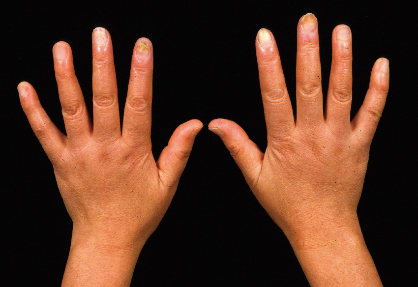 ⓔ図13-7-1　混合性結合組織病 (MCTD) のソーセージ様手指と手背の腫脹 