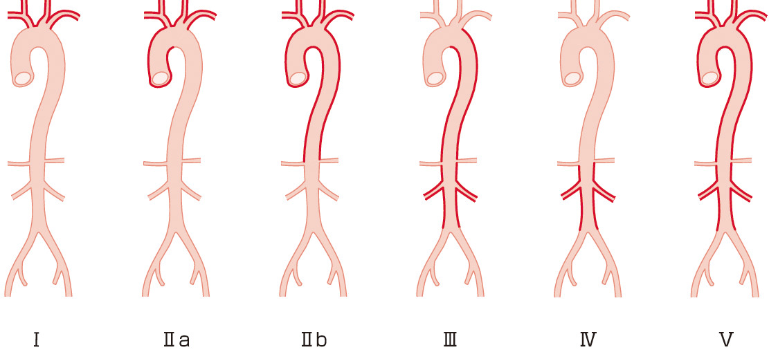 ⓔ図13-8-1　高安動脈炎の沼野分類I～V型 (日本循環器学会，日本リウマチ学会，他：血管炎症候群の診療ガイドライン 2017年改訂版，2018) 