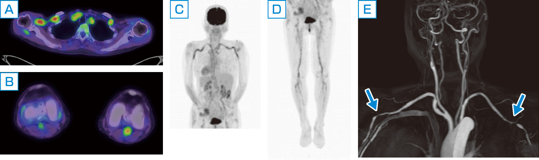 ⓔ図13-8-3　巨細胞性動脈炎患者の大型血管病変 A～D：18F–FDG–PET/CT所見．胸部・腹部大動脈壁にFDG集積亢進を認める．弓部三分枝から両側頸動脈，両側鎖骨下動脈から腋窩動脈，下肢動脈にFDG集積亢進を認める．浅側頭動脈付近には目立った集積はない． E：MRA所見．左内頸動脈は起始部からびまん性に狭小化している．右内頸動脈はやや細めだが描出されている．両側腋窩動脈に中等度以上の狭窄あり．左腋窩動脈には狭窄後拡張がみられる．