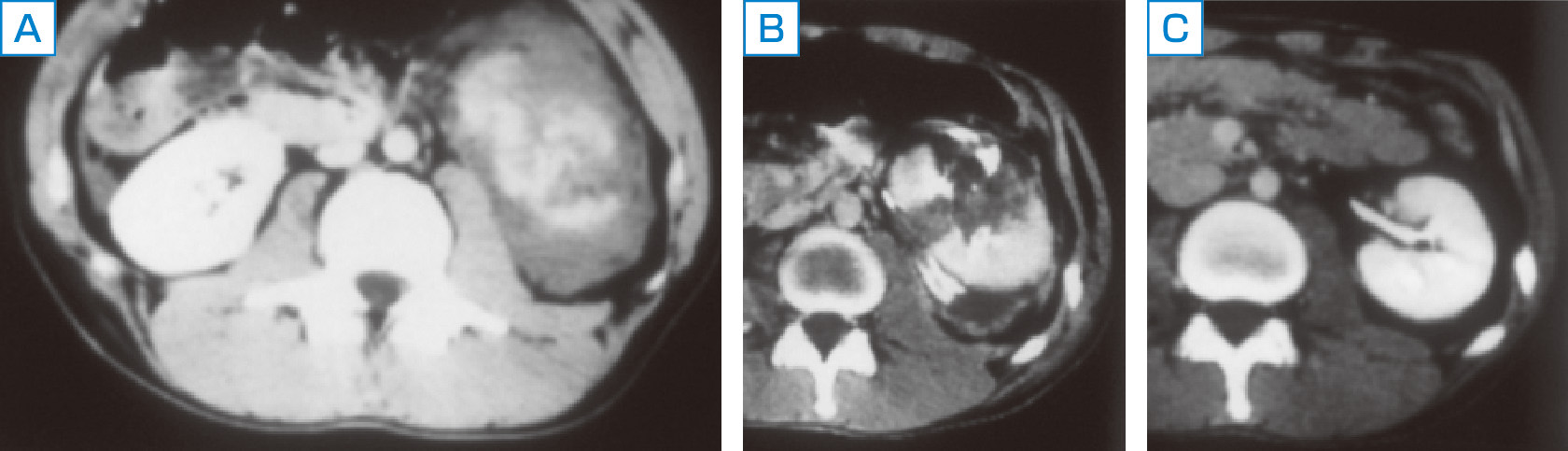 ⓔ図14-1-12　左腎外傷後に対する保存療法による経時的変化 A：受傷直後．腎破裂と血腫形成． B：受傷1カ月後．血腫が吸収されつつある． C：受傷半年後．腎周囲血腫は自然吸収された．