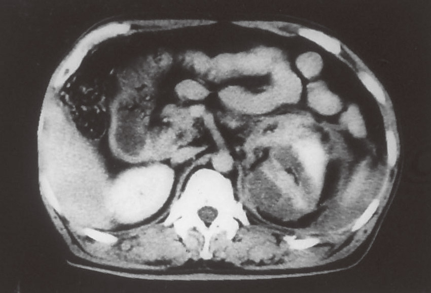 ⓔ図14-1-13　左腎外傷 50歳代，男性．ひき逃げ事故で左腎損傷．骨盤骨折・肋骨骨折．左腎外傷に対し保存的治療施行．約1カ月後，左腎から出血 (後出血)．→ 膀胱タンポナーゼ．出血コントロール困難→ 左腎動脈塞栓術 (TAE) 施行．総出血量：8400 mL．