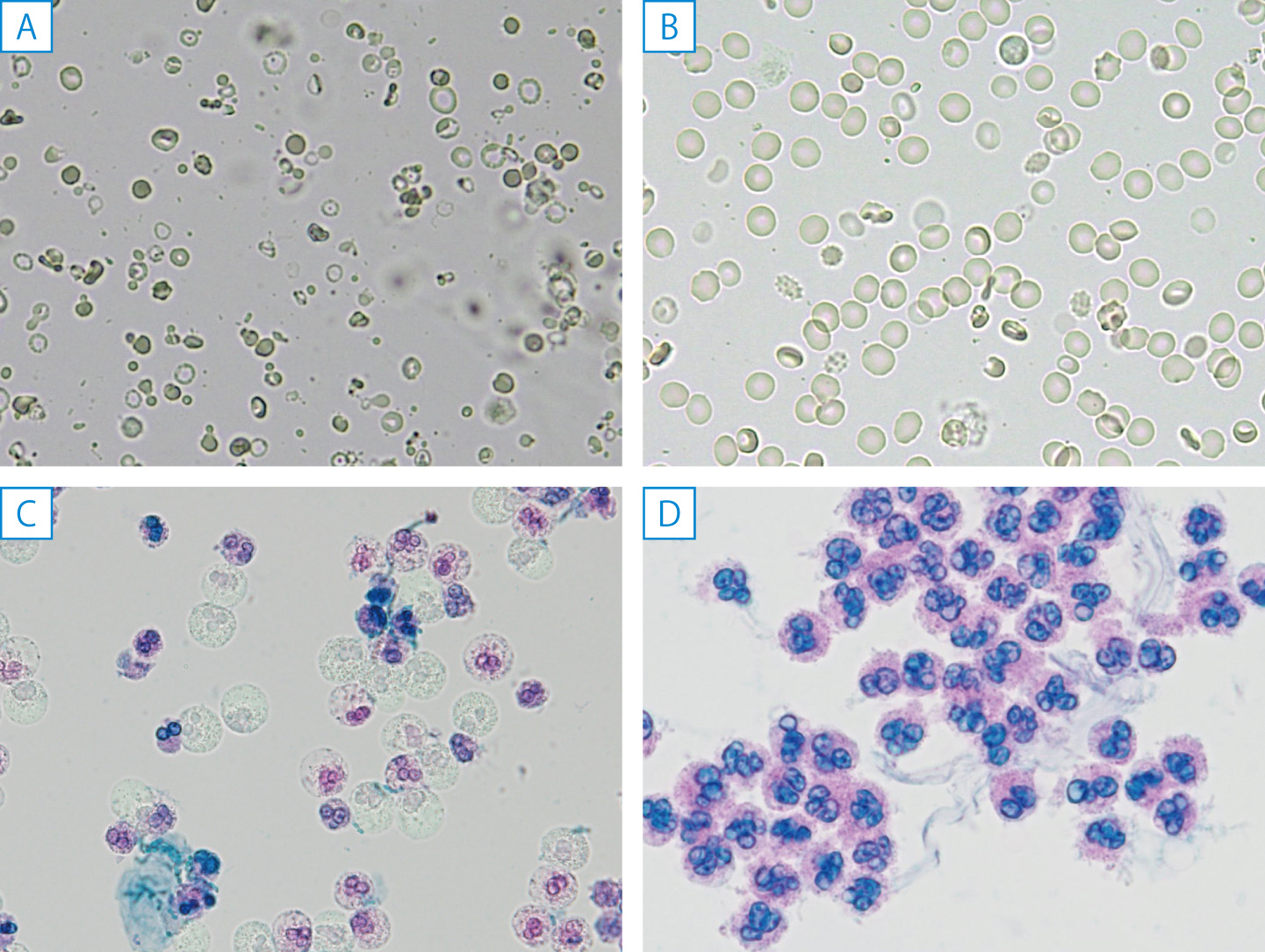 ⓔ図14-1-3　尿沈渣 (赤血球と白血球) A：変形した多彩な赤血球，B：均一な赤血球，C：pale cell (glitter cell)，D：dark cell．