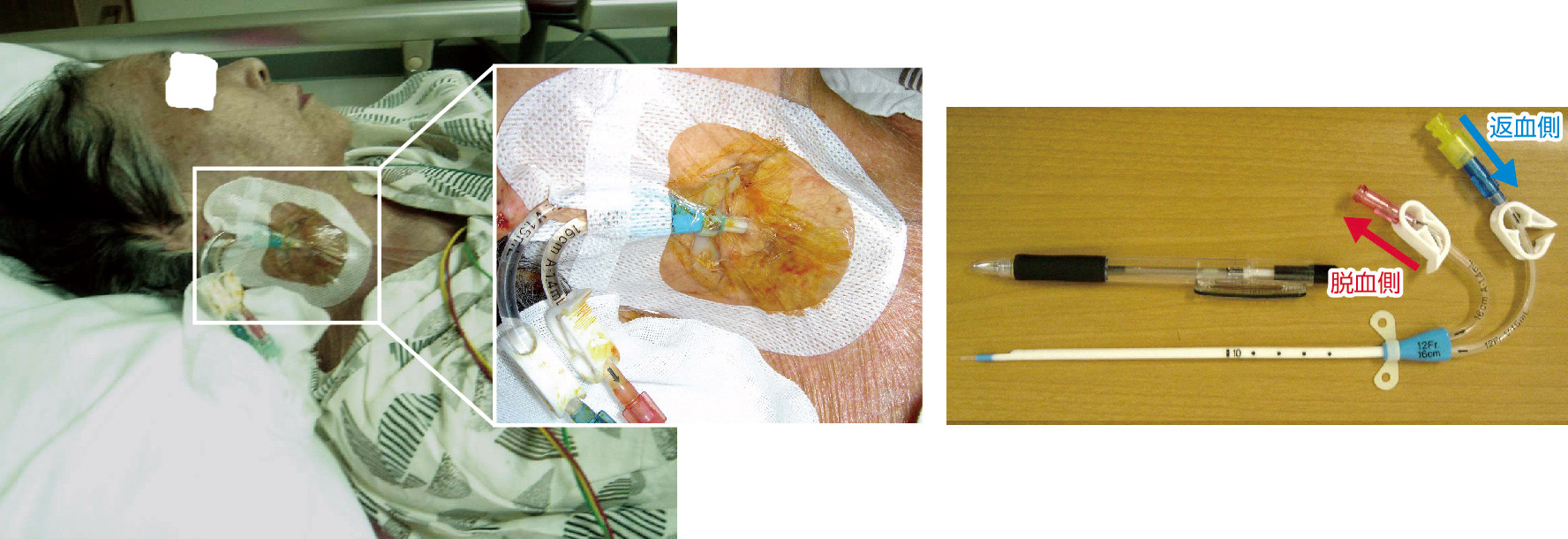 ⓔ図14-1-8　ブラッドアクセスカテーテル 