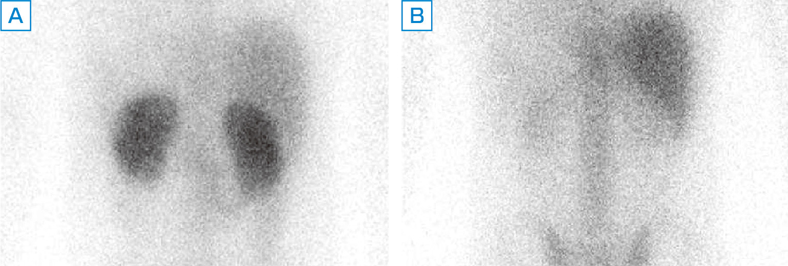 ⓔ図14-13-2　急性間質性腎炎患者におけるGaシンチグラフィの所見 (Akimoto T, Horikoshi R, et al: Saudi J Kidney Dis Transpl, 2014; 25: 864–868 より作成) A：薬剤性の急性間質性腎炎の患者に 67Ga投与後48時間でスキャンしたGaシンチグラフィの画像．両側腎でのGa取り込みが上昇している． B：5カ月後の画像では明らかな腎臓での取り込みは認められず，急性間質性腎炎の炎症が沈静化していることが示された．