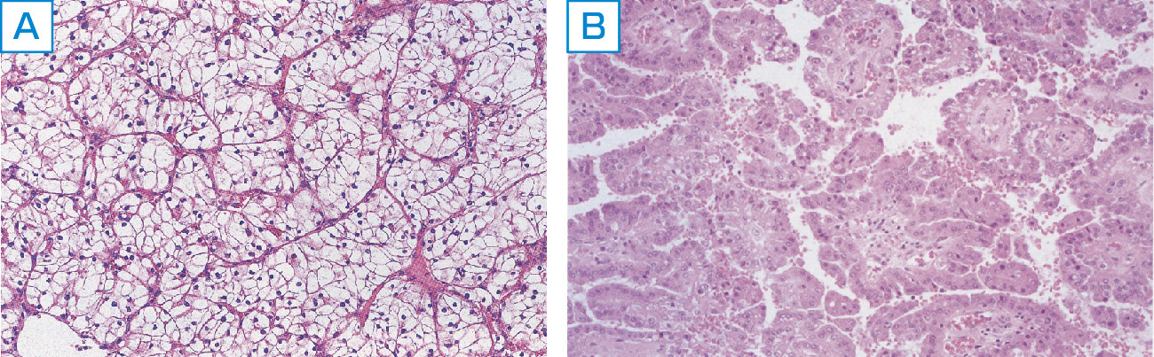 ⓔ図14-14-10　腎細胞癌の病理組織所見 淡明細胞癌 (上段) と乳頭状腺癌 (下段)．
