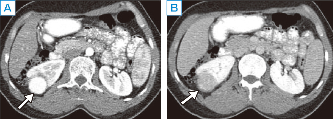 ⓔ図14-14-11　淡明細胞癌のダイナミックCT 早期造影 (A) されwashoutが速い (B) のが特徴．