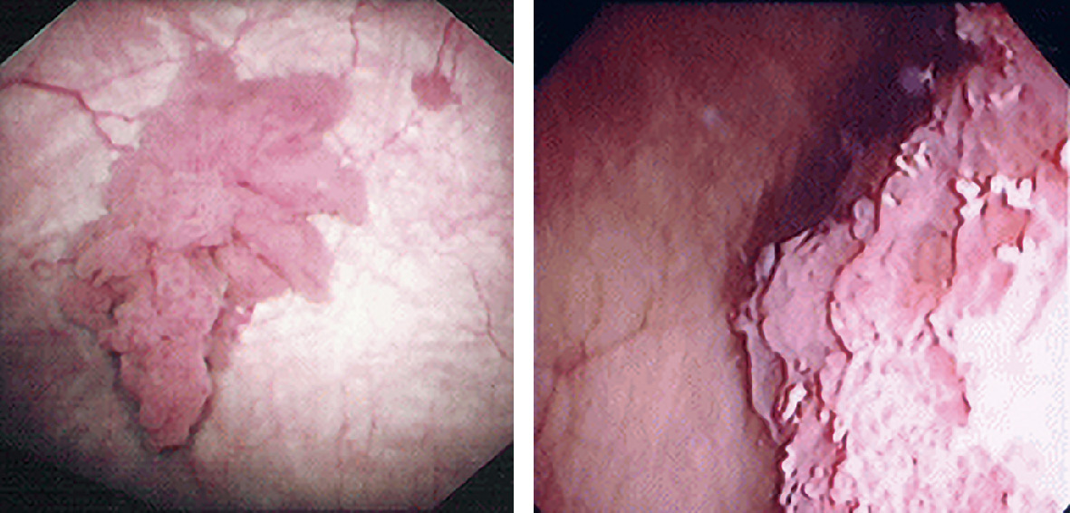 ⓔ図14-14-12　膀胱癌の膀胱鏡所見：非筋層浸潤癌 (左) および筋層浸潤癌 (右) 