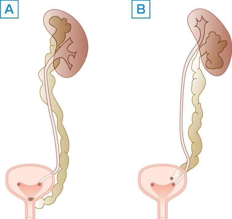 ⓔ図14-14-14　完全重複腎盂尿管に伴う尿管異所開口 A：上腎所属尿管の尿管異所開口 (尿管瘤も伴う)，B：下腎所属尿管の膀胱尿管逆流．