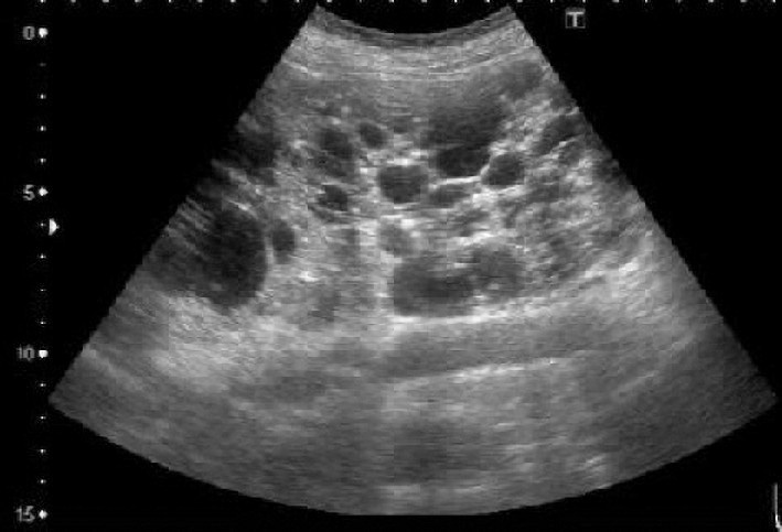 ⓔ図14-14-3　ADPKDの腎超音波検査画像所見 40歳代女性，推算GFR 66 mL/分/1.73 m2，両側腎容積1577 mLのADPKD患者．腎臓に大小のエコー輝度の低い (黒い) 袋様の構造物を多数認める．