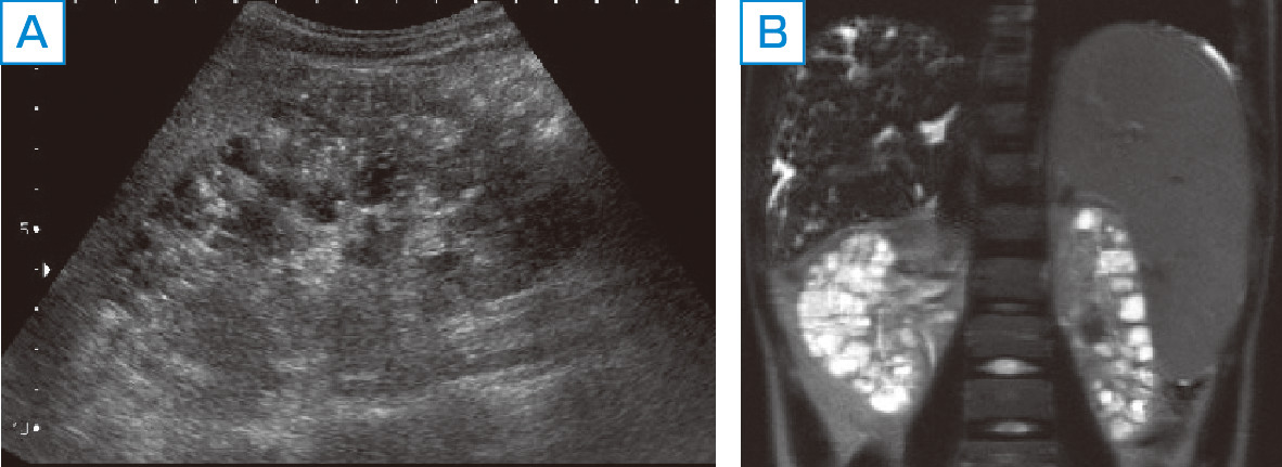 ⓔ図14-14-5　ARPKDの画像所見 15歳，男性症例．A：腎超音波検査画像所見，B：単純MRI検査所見． 大小さまざまな大きさの腎嚢胞を認めるADPKDとは異なり，ARPKDの腎嚢胞は径が比較的小さな嚢胞の集簇が特徴である．本症例は15歳の症例であり，比較的嚢胞形成が進行しており，肉眼的に嚢胞が確認できるmacrocystが主体である．腎超音波画像では腎腫大，皮質髄質の境界の不明瞭化，髄質優位の嚢胞形成に伴う髄質主体の超音波輝度上昇を認める．MRI検査では両腎に多発する腎嚢胞，肝内胆管拡張，著明な脾腫を認める．