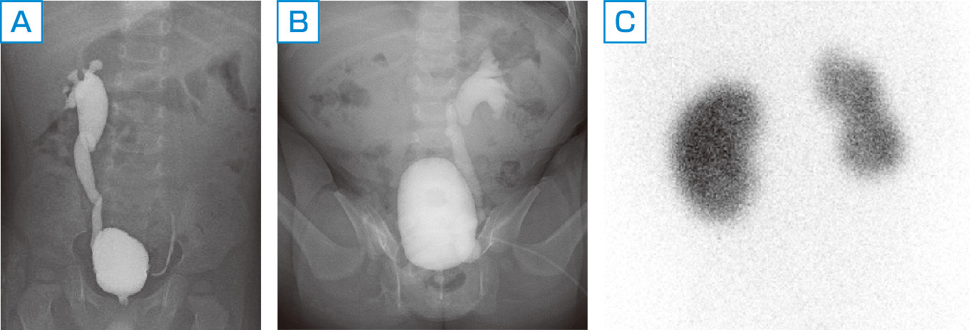 ⓔ図14-14-6　排尿時膀胱尿道造影 (VCUG) A：(右) VURグレードⅣ，(左) VURグレードⅠ． B：VCUG．(左) VURグレードⅤ，右上部尿路への逆流は確認されない． C：99mTc–DMSA腎シンチグラフィ．左腎のuptakeが低下し腎瘢痕が認められている．
