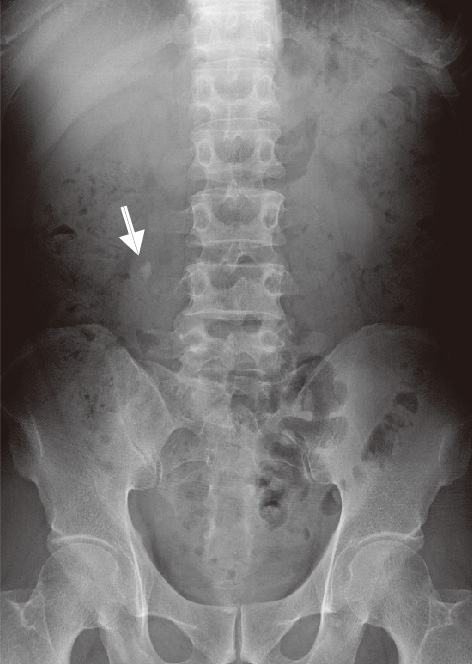 ⓔ図14-14-7　尿管結石の単純X線像 L4右側に石灰化結石が認められる．