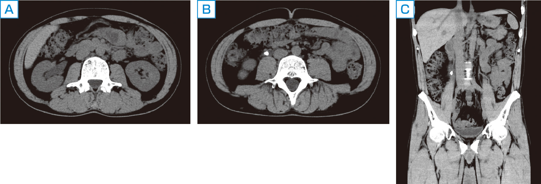 ⓔ図14-14-8　尿管結石のCT画像 A：CT横断像．右水腎症を認める． B：CT横断像．右尿管内に石灰化結石を認める． C：CT冠状断像．右上部尿管内に石灰化結石を認める．