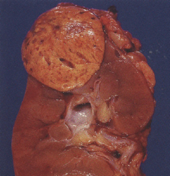 ⓔ図14-14-9　腎細胞癌の肉眼所見 割面，淡明細胞癌．
