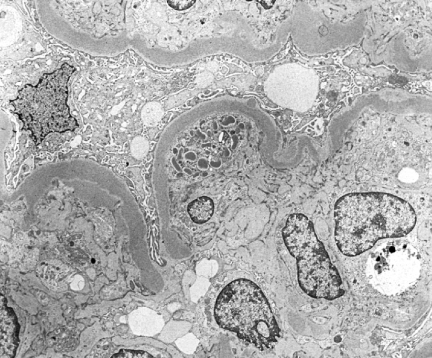 ⓔ図14-3-11　MPGN Ⅱ型の電子顕微鏡像 (岩野正之：内科学第11版 (矢﨑義雄総編集)，朝倉書店，2017) 基底膜内にリボン状の高電子密度沈着物が観察できる．