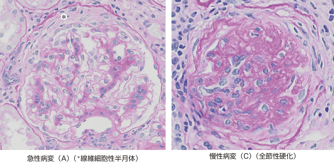 ⓔ図14-3-13　IgA腎症組織重症度分類 (急性病変・慢性病変) 