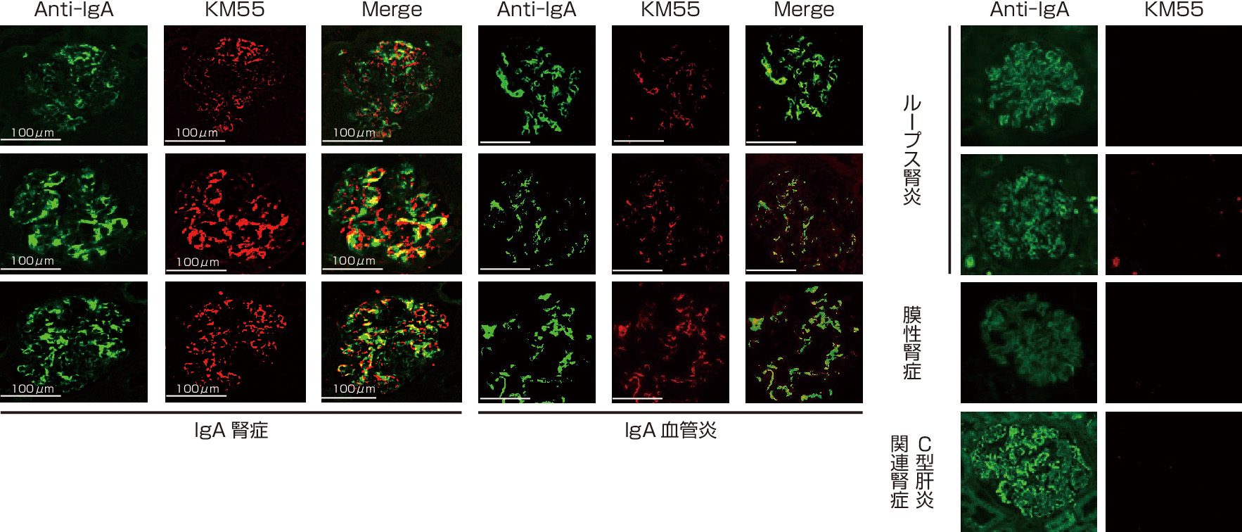 ⓔ図14-3-14　IgA腎症とIgA血管炎の糸球体には糖鎖異常IgAが特異的に沈着している (Suzuki H, Yasutake J, et al: Kidney Int, 2018; 93: 700–705より作成) KM55：抗GdIgA1モノクローナル抗体．