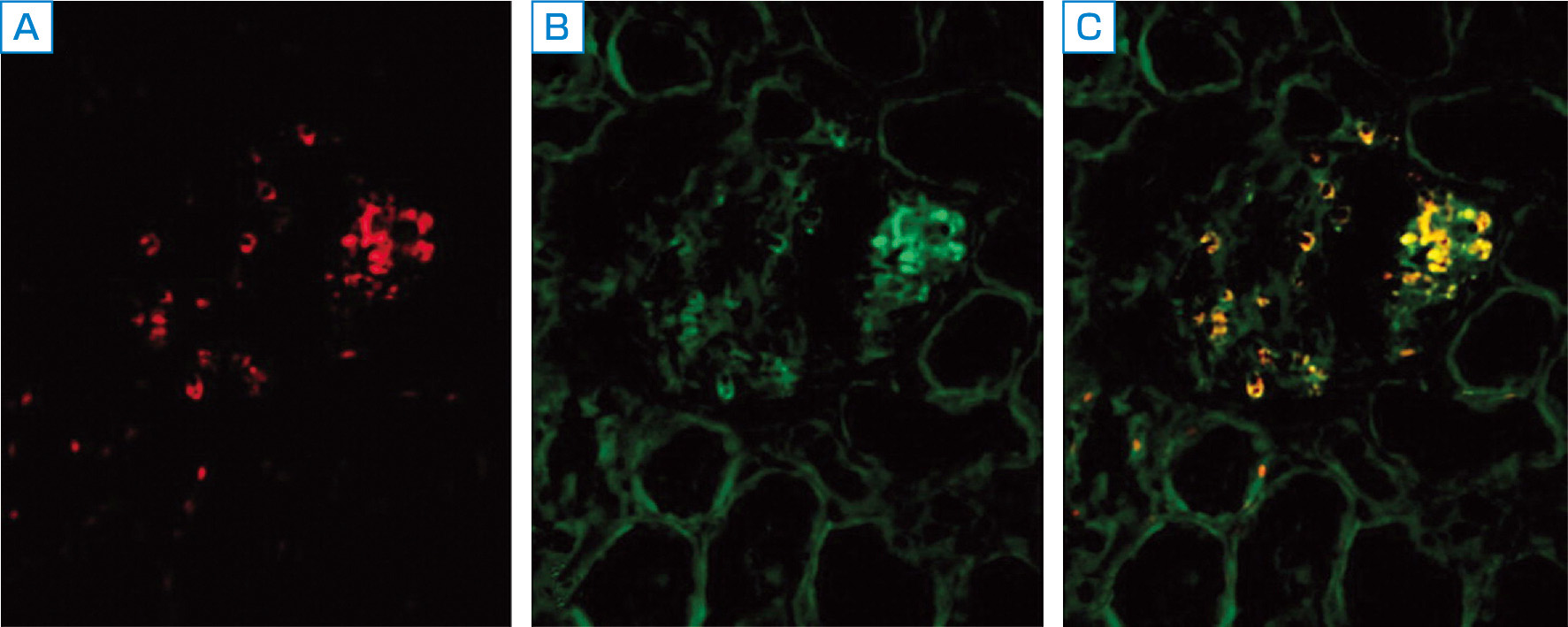 ⓔ図14-3-7　APSGN患者の糸球体におけるNAPlrと SPEBとの共存 (Rodriguez–Iturbe B, Musser JM: J Am Soc Nephrol, 2008; 19: 1855–1864) A：NAPlr染色像 (赤)，B：SPEB，(緑)，C：Double Staining (黄)．NAPlrとSPEBは糸球体内のほぼ同一部位に局在している．