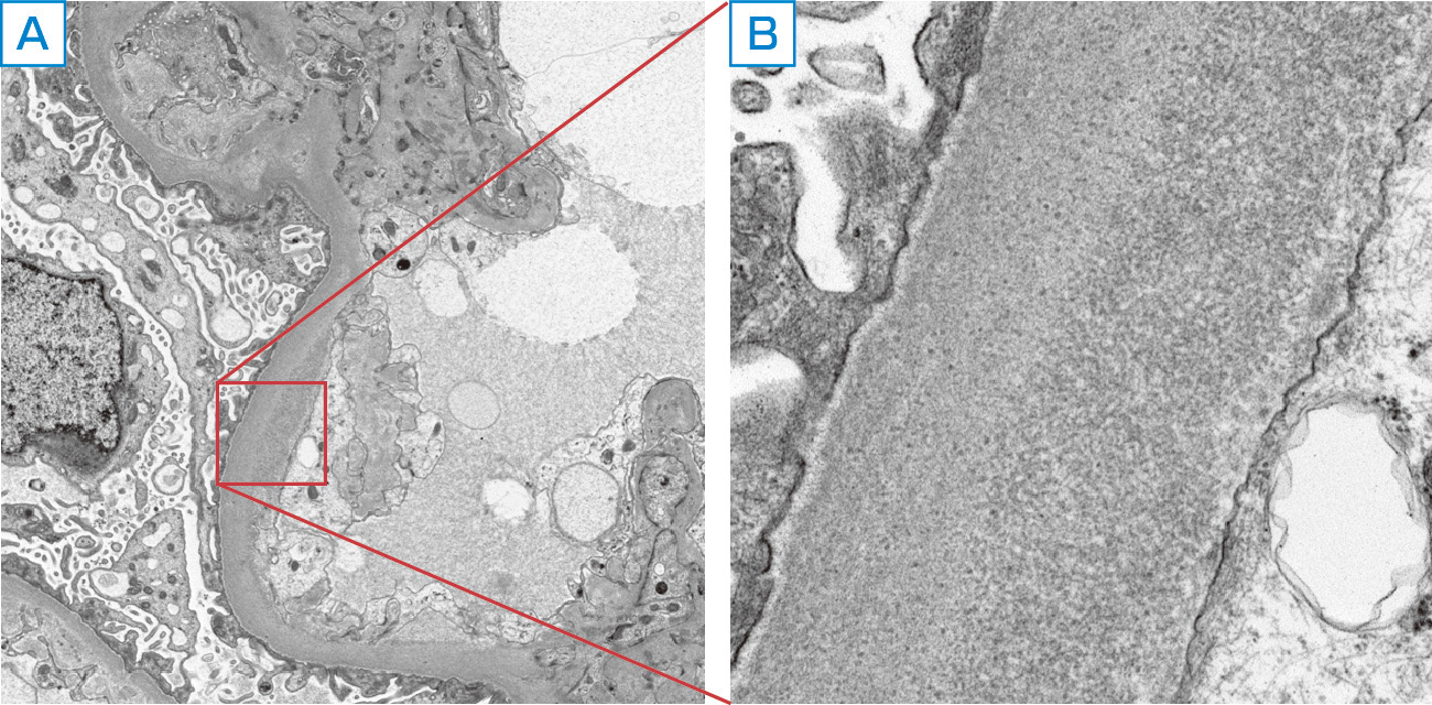 ⓔ図14-6-10　C型肝炎に伴う膜性増殖性腎炎の電子顕微像 (今澤俊之博士提供) 内皮下にクリオグロブリンの沈着を認める．A：8000倍，B：5万倍．