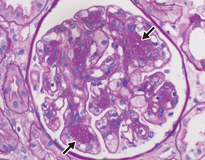 ⓔ図14-6-3　軽鎖沈着症の組織像 (廣村桂樹，野島美久：内科学第11版 (矢﨑義雄総編集)，朝倉書店，2017) 糸球体のメサンギウム領域の結節状の拡大がみられるが (矢印)，メサンギウム細胞の増殖はあまりない (光学顕微鏡，HE染色，×400)．